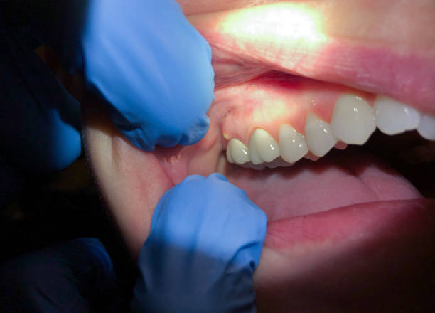 Best Emergency Treatment for Oral Infections in North Pembroke, MA