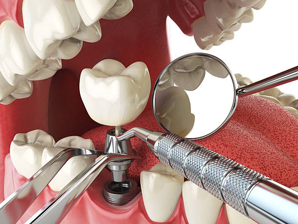 Best Broken or Chipped Tooth Repair in North Pembroke, MA